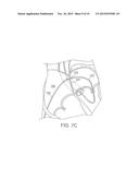 APPARATUS FOR SAFE PERFORMANCE OF TRANSSEPTAL TECHNIQUE AND PLACEMENT AND     POSITIONING OF AN ABLATION CATHETER diagram and image