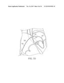 APPARATUS FOR SAFE PERFORMANCE OF TRANSSEPTAL TECHNIQUE AND PLACEMENT AND     POSITIONING OF AN ABLATION CATHETER diagram and image