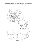 Implantable sling for the treatment of incontinence and method of using     the same diagram and image