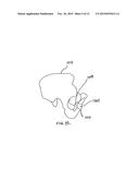 Implantable sling for the treatment of incontinence and method of using     the same diagram and image