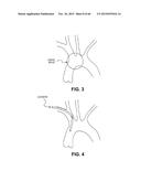 METHOD OF ISOLATING THE CEREBRAL CIRCULATION DURING A CARDIAC PROCEDURE diagram and image