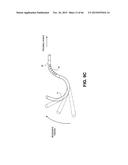 METHOD OF ISOLATING THE CEREBRAL CIRCULATION DURING A CARDIAC PROCEDURE diagram and image