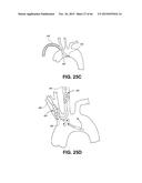 METHOD OF ISOLATING THE CEREBRAL CIRCULATION DURING A CARDIAC PROCEDURE diagram and image