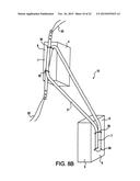 Cortical loop fixation system for ligament and bone reconstruction diagram and image