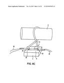 Cortical loop fixation system for ligament and bone reconstruction diagram and image