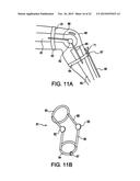 Cortical loop fixation system for ligament and bone reconstruction diagram and image