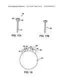 Cortical loop fixation system for ligament and bone reconstruction diagram and image