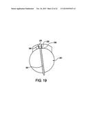 Cortical loop fixation system for ligament and bone reconstruction diagram and image