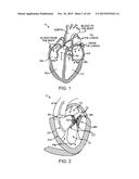 PROSTHETIC HEART VALVE DEVICES, PROSTHETIC MITRAL VALVES AND ASSOCIATED     SYSTEMS AND METHODS diagram and image