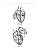 PROSTHETIC HEART VALVE DEVICES, PROSTHETIC MITRAL VALVES AND ASSOCIATED     SYSTEMS AND METHODS diagram and image