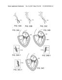 PROSTHETIC HEART VALVE DEVICES, PROSTHETIC MITRAL VALVES AND ASSOCIATED     SYSTEMS AND METHODS diagram and image