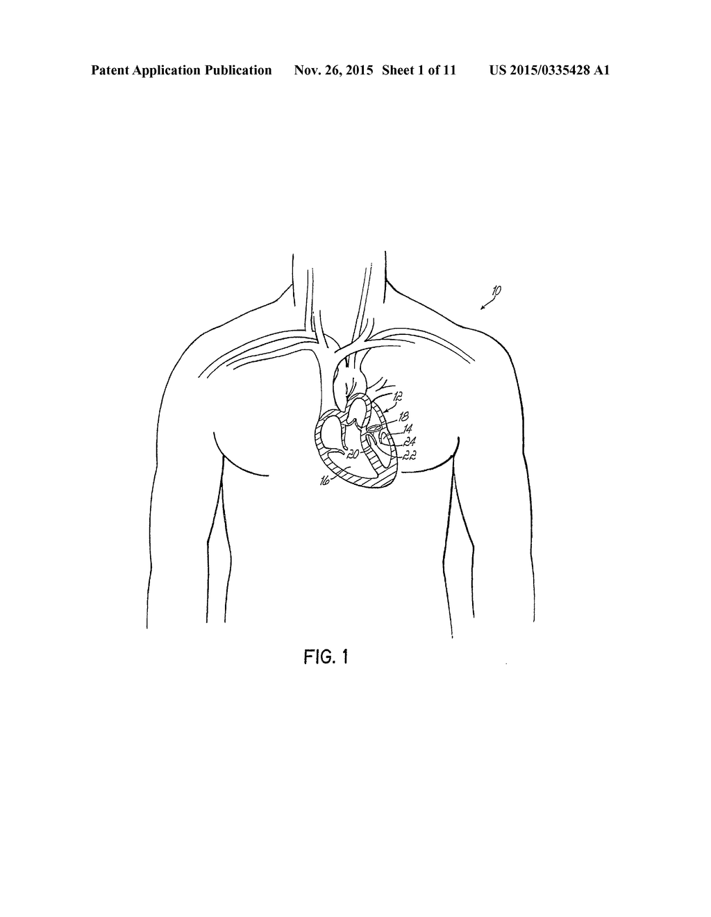 Device And Method For Improving The Function Of A Heart Valve - diagram, schematic, and image 02