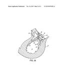 Device And Method For Improving The Function Of A Heart Valve diagram and image