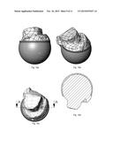 Medical Implant for Reducing Pain in Diseased Joints diagram and image