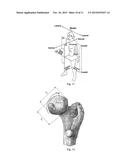 Medical Implant for Reducing Pain in Diseased Joints diagram and image