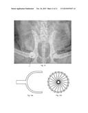 Medical Implant for Reducing Pain in Diseased Joints diagram and image