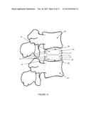 Elastomeric Artificial Joints and Intervertebral Prosthesis Systems diagram and image