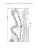 Treatment for Obesity by Selectively Clipping the Gastric Fundus to Modify     Blood Flow diagram and image