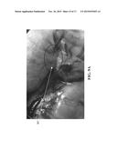 Treatment for Obesity by Selectively Clipping the Gastric Fundus to Modify     Blood Flow diagram and image