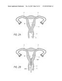 INTRAUTERINE CONTRACEPTIVE DEVICE diagram and image