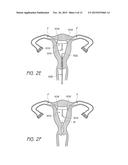 INTRAUTERINE CONTRACEPTIVE DEVICE diagram and image