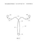 INTRAUTERINE CONTRACEPTIVE DEVICE diagram and image