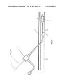 CATHETER WITH MARKINGS TO FACILITATE ALIGNMENT diagram and image