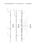 RADIOPAQUE BALLOON CATHETER AND GUIDEWIRE TO FACILITATE ALIGNMENT diagram and image