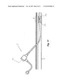 RADIOPAQUE BALLOON CATHETER AND GUIDEWIRE TO FACILITATE ALIGNMENT diagram and image