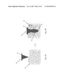 SWELLABLE ADHESIVE NEEDLES diagram and image