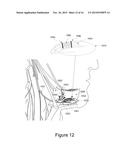 Electrode Configuration for Implantable Modulator diagram and image