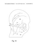 Electrode Configuration for Implantable Modulator diagram and image