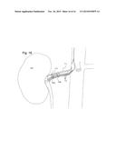 Electrode Configuration for Implantable Modulator diagram and image