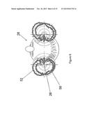 HEARING DEVICE diagram and image