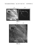 CALCULATING A FRACTIONAL FLOW RESERVE diagram and image