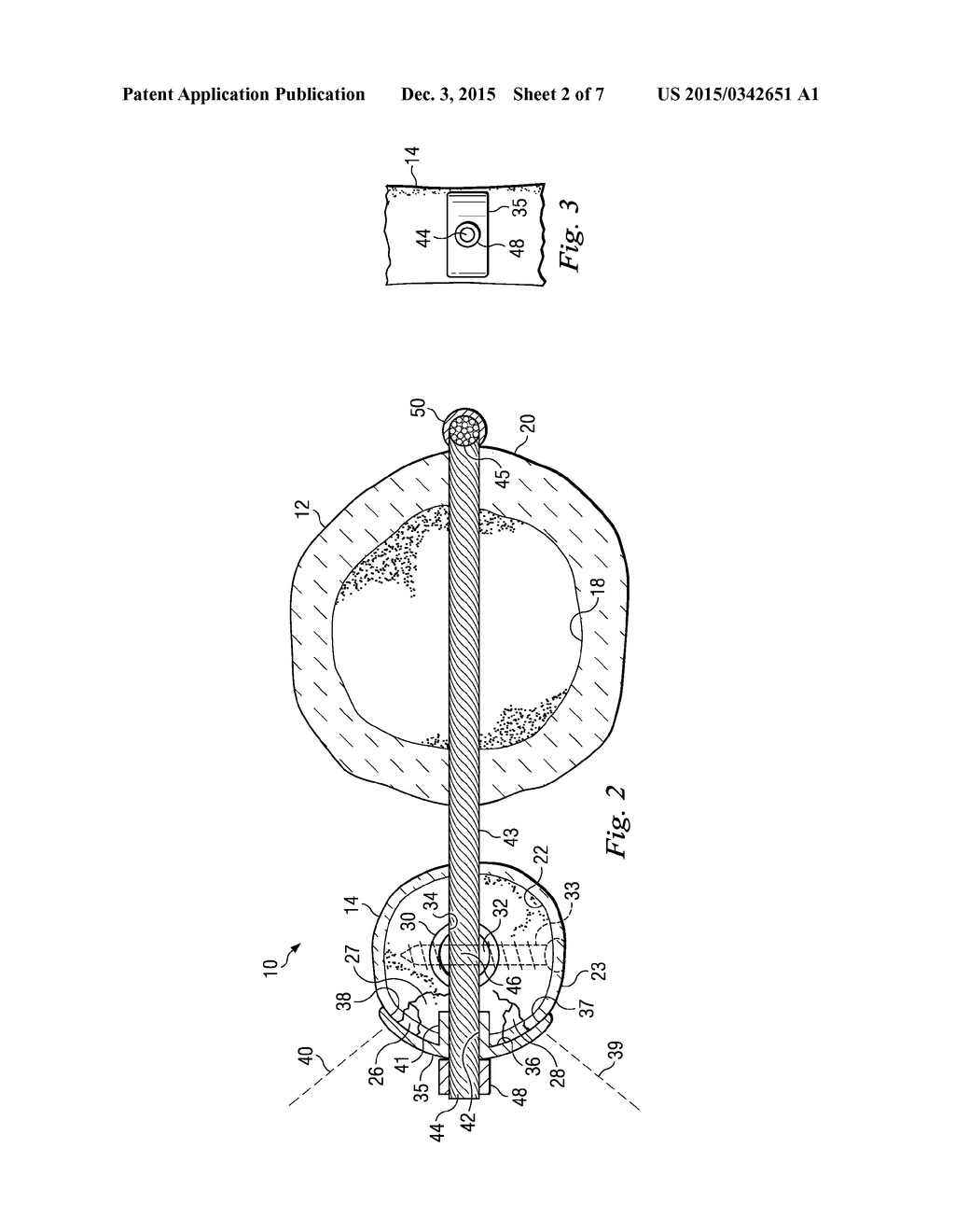 Bone Fixation System and Method of Use - diagram, schematic, and image 03