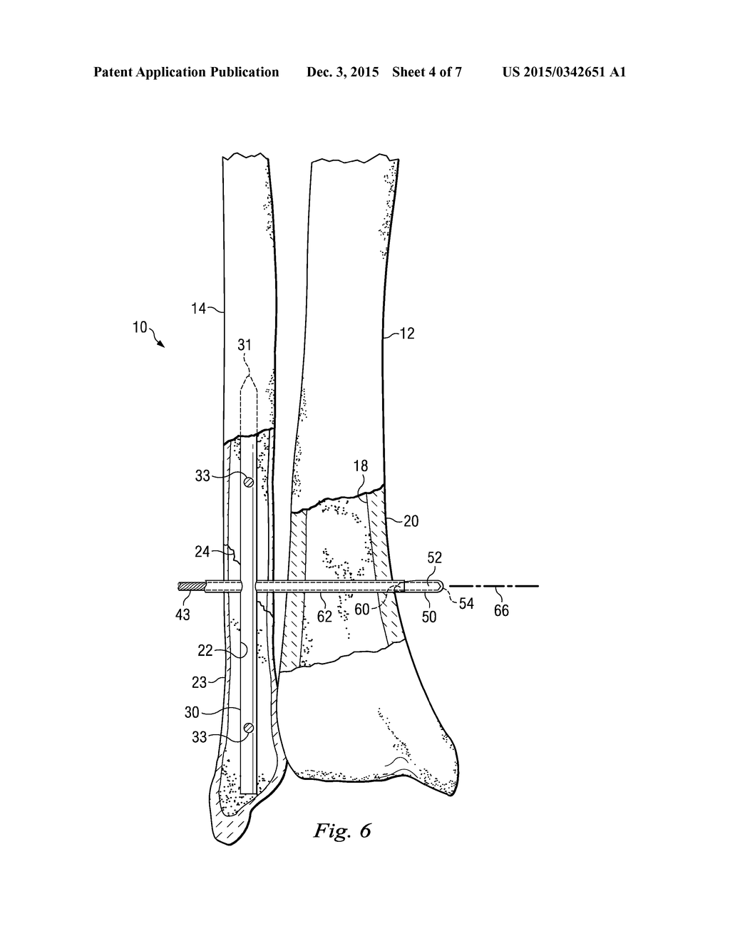 Bone Fixation System and Method of Use - diagram, schematic, and image 05