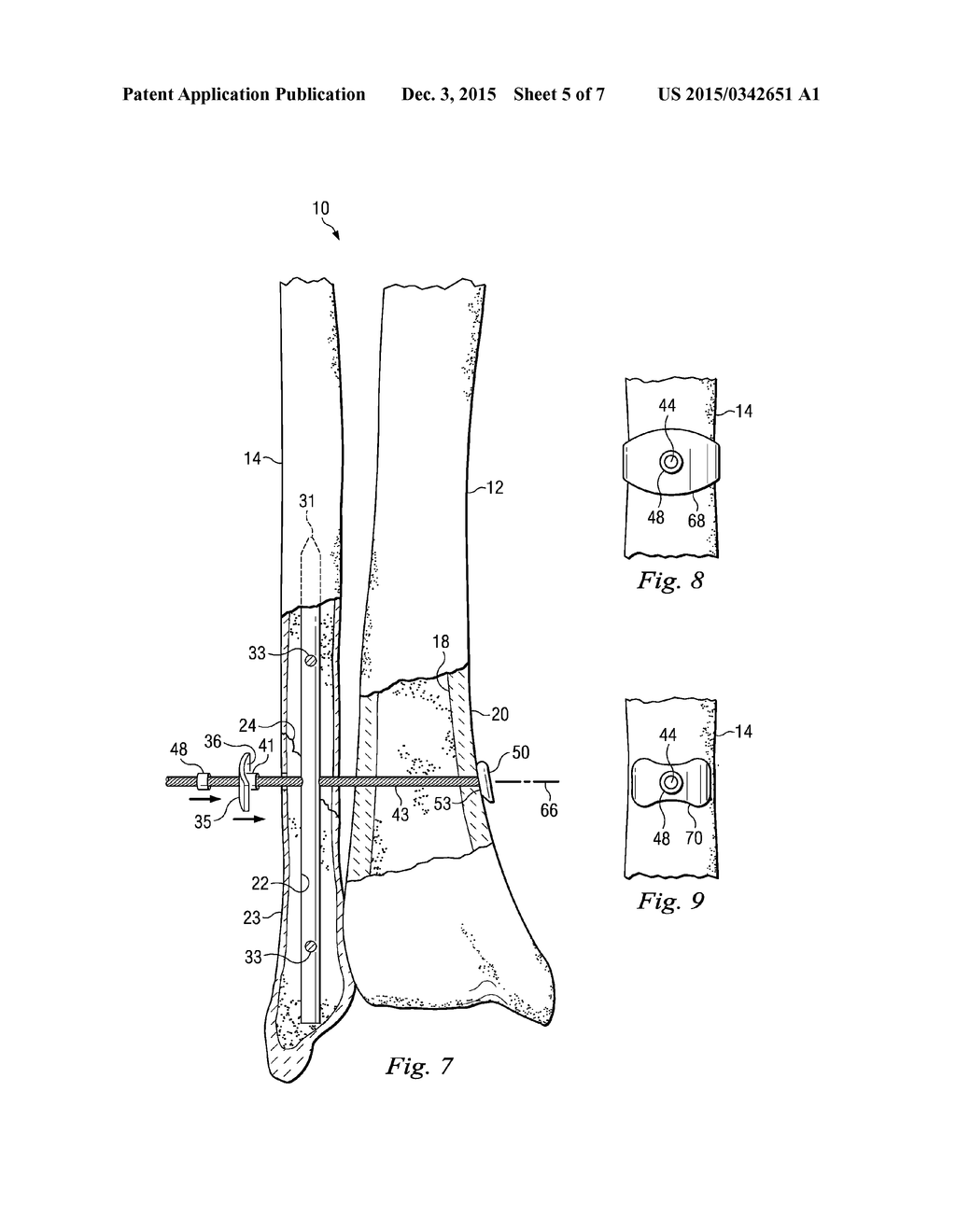 Bone Fixation System and Method of Use - diagram, schematic, and image 06