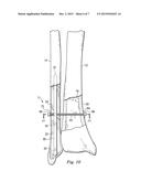 Bone Fixation System and Method of Use diagram and image