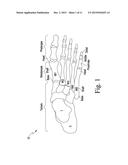 METATARSAL FIXATION DEVICE, SYSTEM AND METHOD diagram and image