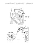 IDENTIFICATION AND VISUALIZATION OF GAPS BETWEEN CARDIAC ABLATION SITES diagram and image