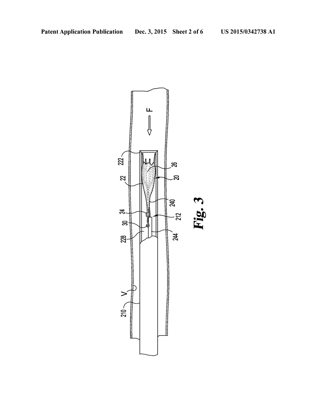 PERIPHERAL SEALING VENOUS CHECK-VALVE - diagram, schematic, and image 03