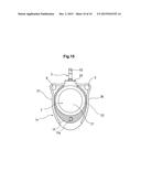 LIQUID MEDICINE INJECTION DEVICE OF SUBCUTANEOUS IMPLANT TYPE diagram and image