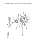 METHODS AND DEVICES TO DECREASE TISSUE TRAUMA DURING SURGERY diagram and image