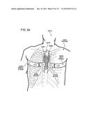 METHODS AND DEVICES TO DECREASE TISSUE TRAUMA DURING SURGERY diagram and image