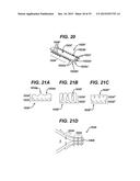 Methods and Devices for Reinforcing a Staple Line diagram and image