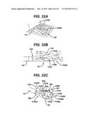 Methods and Devices for Reinforcing a Staple Line diagram and image