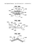 Methods and Devices for Reinforcing a Staple Line diagram and image