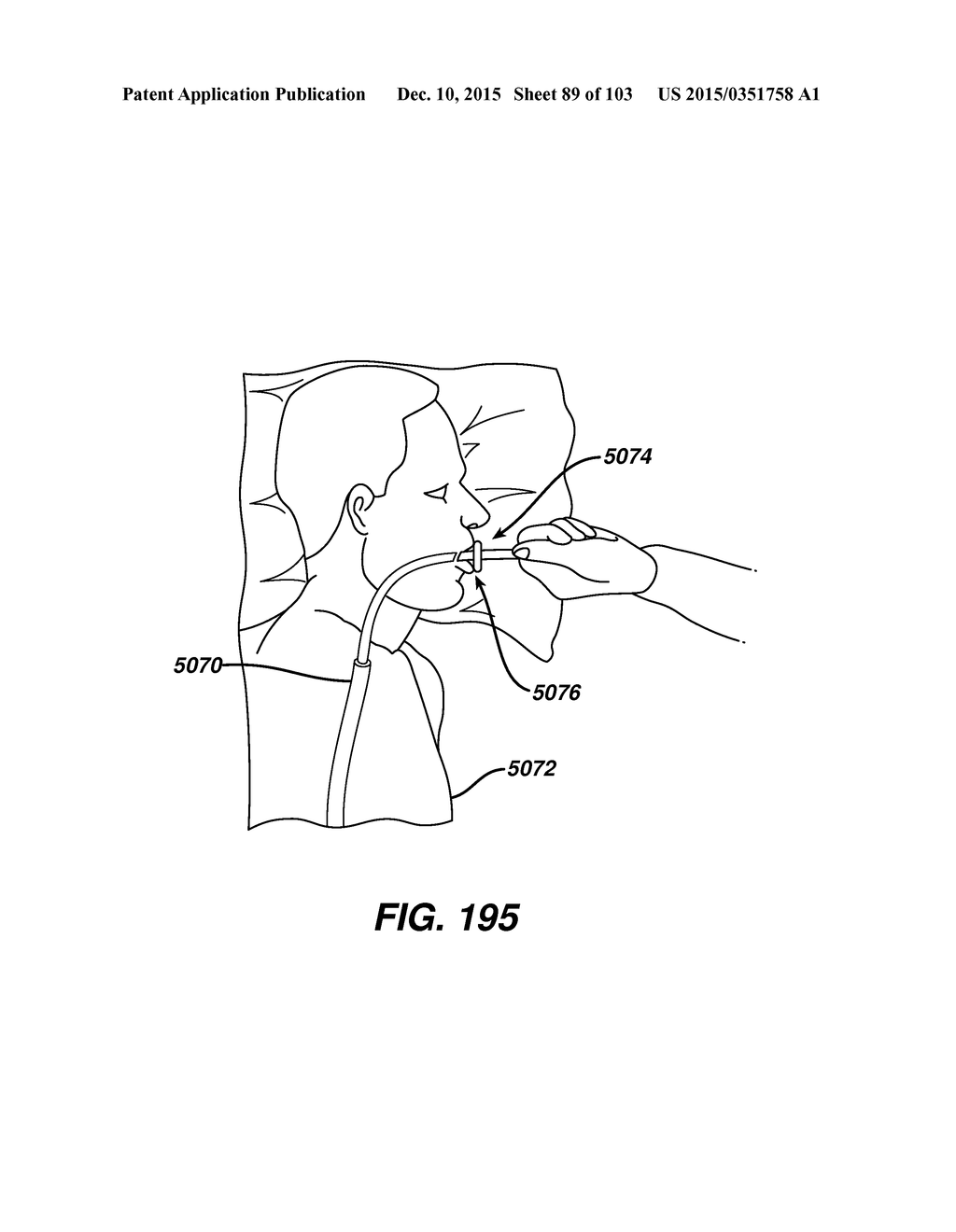 ADJUNCT MATERIALS AND METHODS OF USING SAME IN SURGICAL METHODS FOR TISSUE     SEALING - diagram, schematic, and image 90