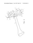 ORTHOPAEDIC AIMING DEVICE FOR COMPOUND SCREW TRAJECTORIES diagram and image